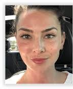BFacial